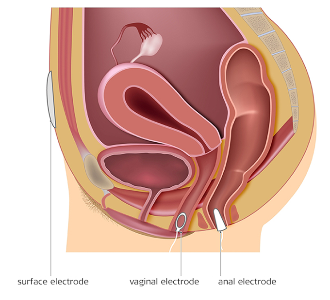 STIWELL Incontinence treatment STIWELL Incontinence treatment