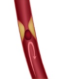 Ischemic stroke Ischemic stroke