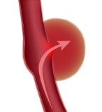 Hemorrhagic stroke Hemorrhagic stroke