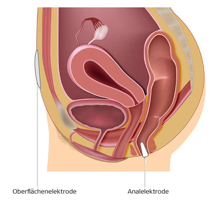 Elektrotherapie - Behandlung Stuhlinkontinenz Elektrotherapie - Behandlung Stuhlinkontinenz