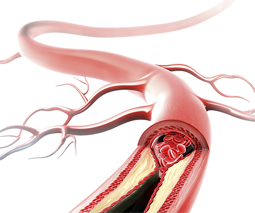 Causes of stroke Causes of stroke