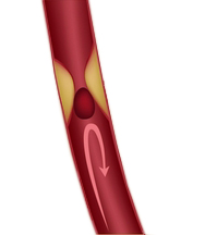 Reduced blood flow (ischaemic stroke, cerebral infarction) Reduced blood flow (ischaemic stroke, cerebral infarction)