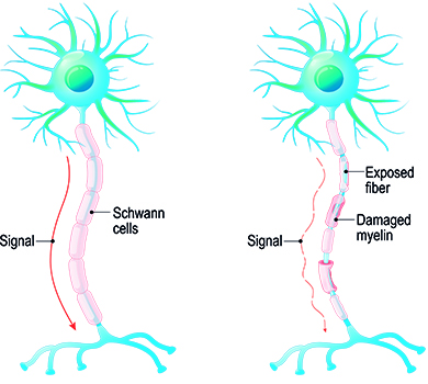 Multiple Sclerosis (MS) - Symptoms, Progression, Diagnosis, Etc. | STIWELL