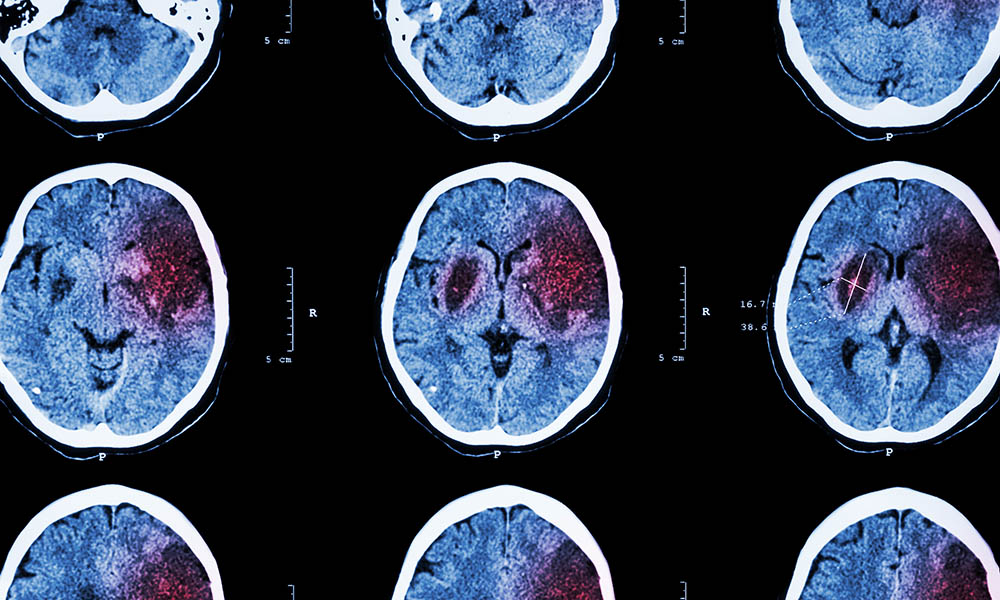 Consequences of a stroke Consequences of a stroke