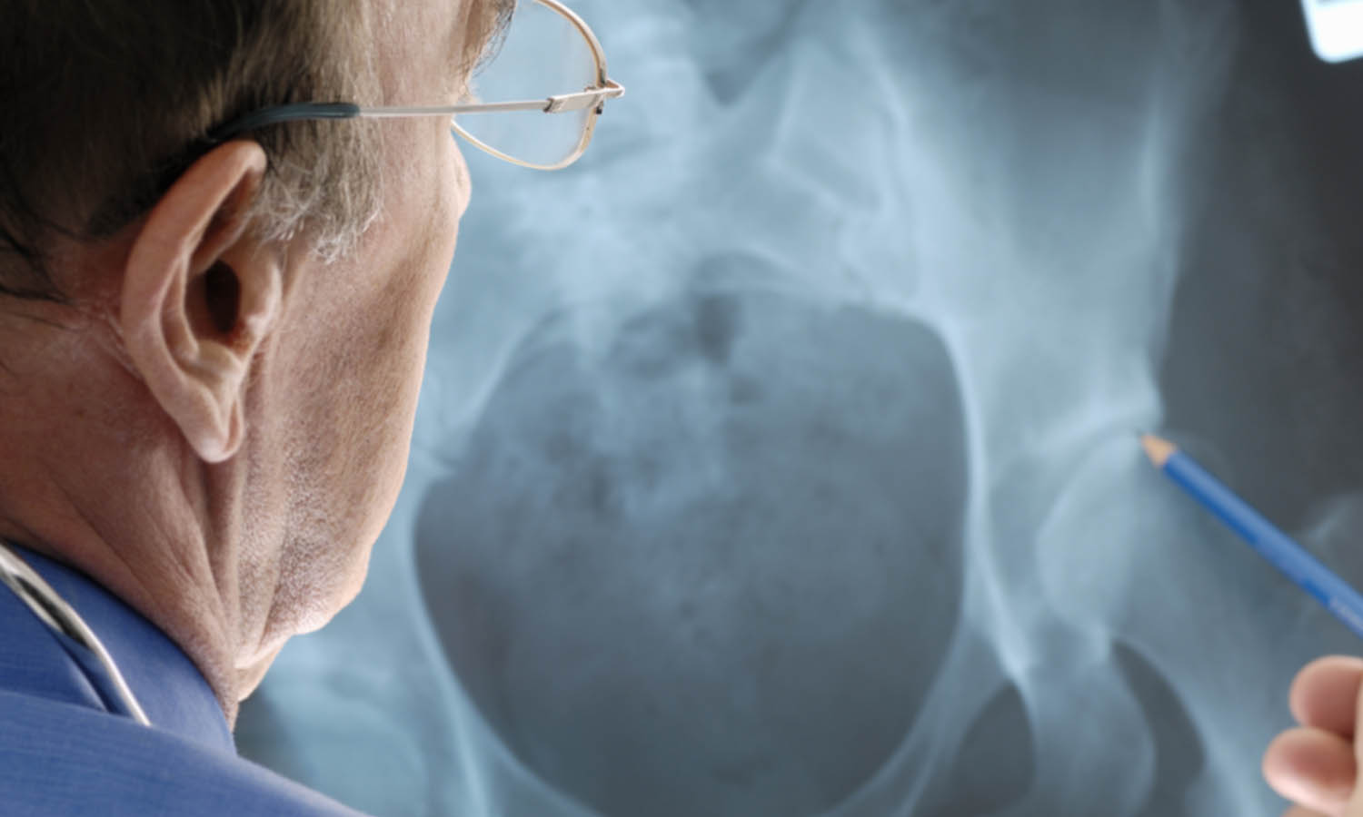 Diagnose: Hüftarthrose Diagnose: Hüftarthrose