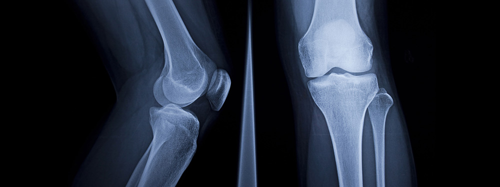Diagnosis of gonarthrosis (knee arthrosis) Diagnosis of gonarthrosis (knee arthrosis)
