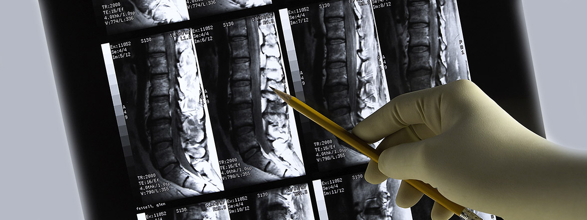 Diagnosis of tetraplegia Diagnosis of tetraplegia