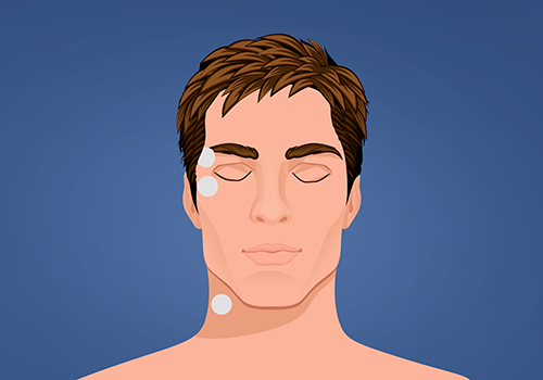 STIWELL therapy | activation of eyelid closure STIWELL therapy | activation of eyelid closure