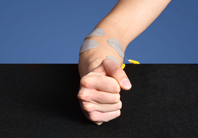 Electrical stimulation to reduce swelling in patients with CRPS Electrical stimulation to reduce swelling in patients with CRPS