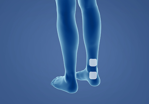 STIWELL therapy | overactive bladder STIWELL therapy | overactive bladder