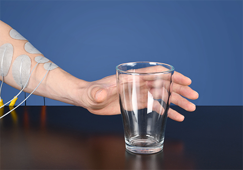 Ataxia: therapy and treatment Ataxia: therapy and treatment