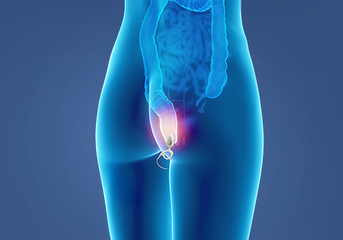STIWELL Therapie | Stuhlinkontinenz STIWELL Therapie | Stuhlinkontinenz