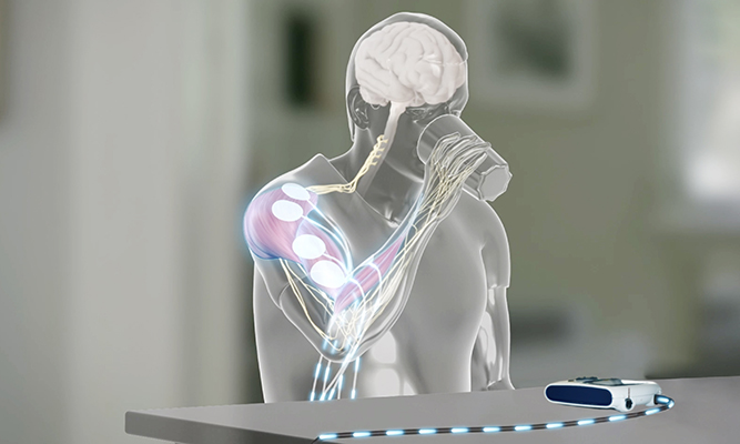 STIWELL Neurorehabilitation | Funktionsprinzip der FES STIWELL Neurorehabilitation | Funktionsprinzip der FES
