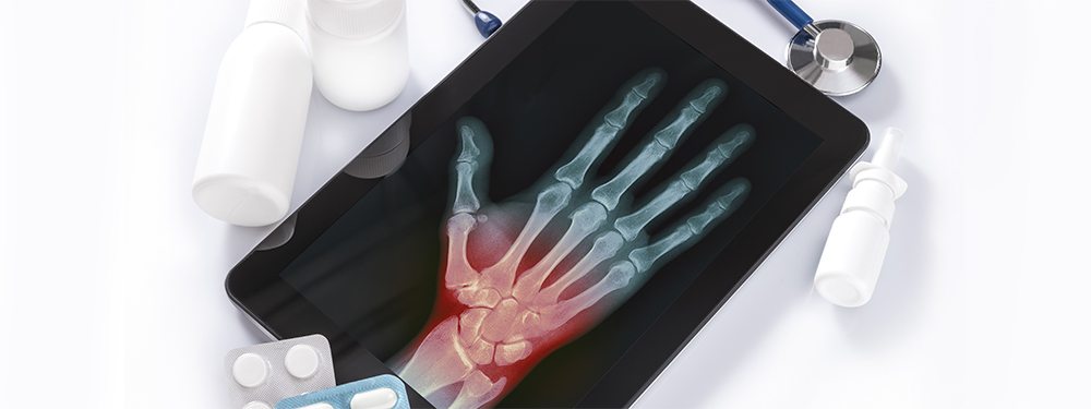 Symptome des komplexen regionale Schmerzsyndroms (CRPS) Symptome des komplexen regionale Schmerzsyndroms (CRPS)