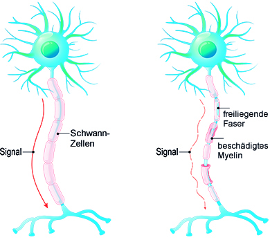 Multiple Sklerose Ms Symptome Verlauf Diagnose Stiwell