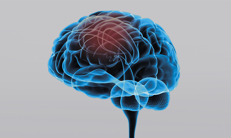 What is a central plegia? What is a central plegia?