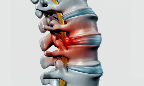 What is a herniated disc? What is a herniated disc?