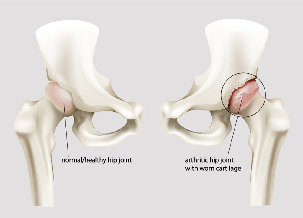 What is hip arthrosis? What is hip arthrosis?