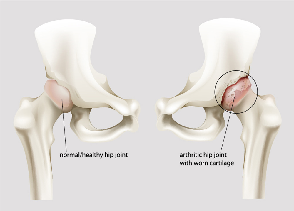 Hip Arthrosis Causes Symptoms Therapy Etc Stiwell