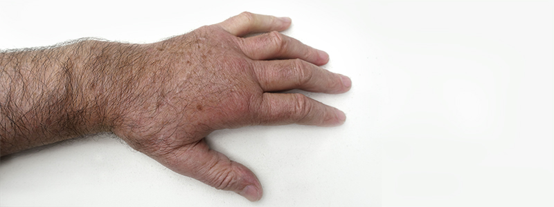 What is complex regional pain syndrome (CRPS)? What is complex regional pain syndrome (CRPS)?